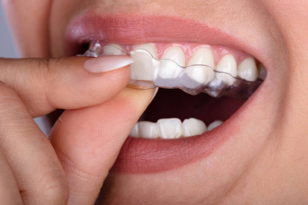 clear-aligners-img